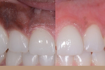 BClinic - Dental Clinic - Services - Gum Depigmentation