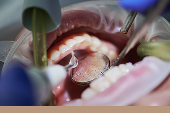 BClinic - Dental Clinic - Services - Screening Of Oral Cancers