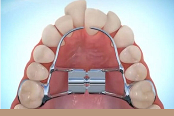 BClinic - Dental Clinic - Services - Expanders 