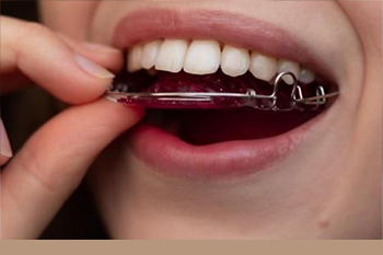 BClinic - Dental Clinic - Services - Retainers 