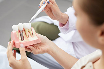 BClinic - Dental Clinic - Services - Dental Implants