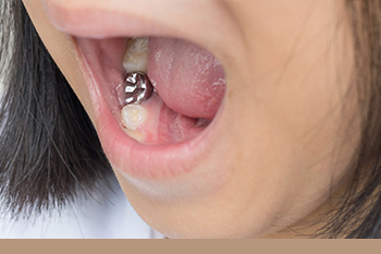 BClinic - Dental Clinic - Services - Dental Crowns